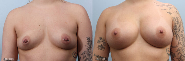 A photo of a woman's body before and after Bilateral Breast Augmentation procedure. Before photo shows a narrow space between her petite breasts, leading to a less pronounced cleavage and smaller in terms of volume. While the after photo shows a rounded shape breasts and a well-distributed volume, both at the top and bottom of her breasts, creating a balanced and full appearance. | Albany, Latham, Saratoga NY, Plastic Surgery