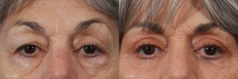 A photo of a woman's upper face before and after the Bilateral Lower Lid Transconjunctival Blepharoplasty procedure. Before photo shows the presence of extra or surplus skin on her upper eyelids, causing to partially covers the natural crease and obscuring part of her eyelids itself. While the after photo shows a lifted eyelids, where the skin appearing more elevated or raised, highlighting the flexibility and firmness of her skin. | Albany, Latham, Saratoga NY, Plastic Surgery