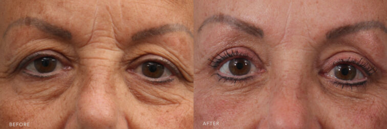 A photo of a woman's upper face before and after Sliver Upper Blepharoplasty procedure. Before photo shows a swollen skin around her eye area, manifesting an accumulation of fat deposits and leading to a sagging or baggy appearance. While the after photo shows the absense of wrinkles and the overall tightness of her skin, indicating that the skin around her eyes appears lifted and firm. | Albany, Latham, Saratoga NY, Plastic Surgery