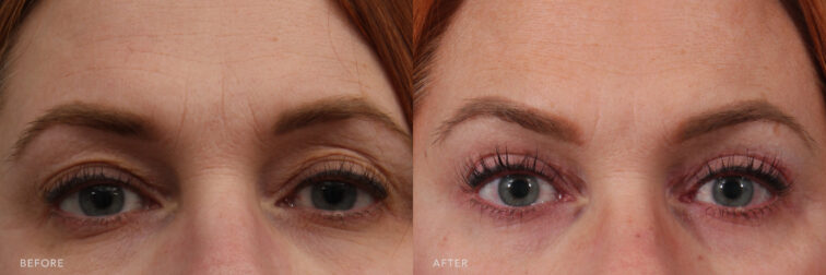 A photo of a woman's upper face before and after Upper Blepharoplasty procedure. Before photo shows protruding or displaced fat deposits in her upper eyelids, leading to a puffy or heavy appearance. While the after photo exhibits a firm and elastic quality, contributing to a more youthful and lifted appearance. | Albany, Latham, Saratoga NY, Plastic Surgery
