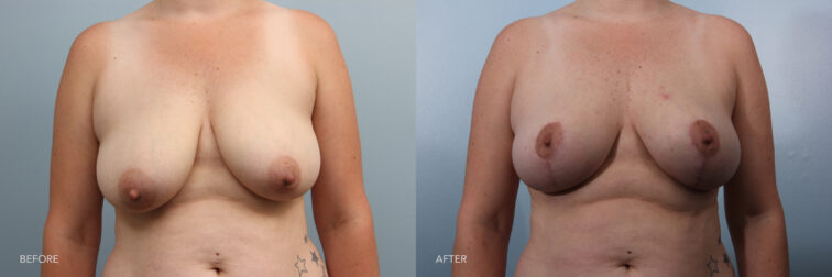 A photo of a woman's upper body before and after Bilateral Mastopexy procedure. Before photo shows a loosened contour of her breasts, reflecting natural changes and resulting in a more relaxed appearance. While the after photo shows tightness in her breast tissue, contributing to a lifted look and maintaining a taut appearance. | Albany, Latham, Saratoga NY, Plastic Surgery