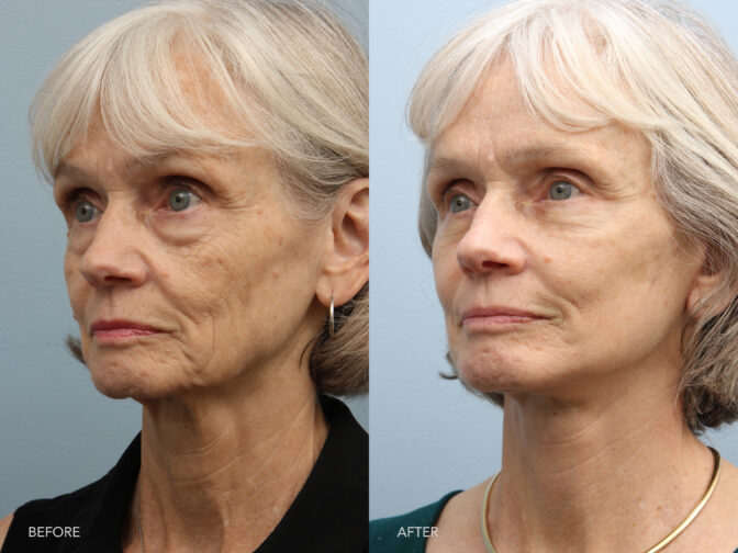 A side-by-side view of a woman's face before and after the Deep Plane Lower Face and Neck Lift procedure. Before photo shows loss of natural contour and curvature of her jawline, resulting in a flatter or less sculpted profile. While the after photo shows clear angles, creating a noticeable separation between the jawbone and the surrounding soft tissues. | Albany, Latham, Saratoga NY, Plastic Surgery