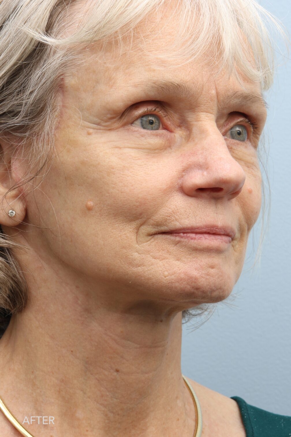 FL141 Lower Face & Neck Lift Albany, Latham, Saratoga NY Williams