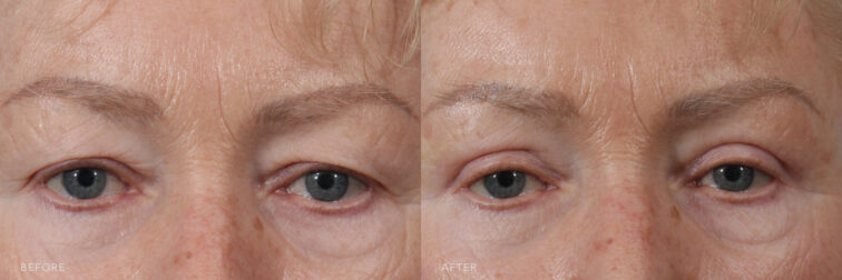 A photo of a woman's upper face before and after Excision of Bilateral Upper Eyelid procedure. Before photo shows a draped or hooded effect, with her skin folding over her natural eye contour. While the after photo shows her gracefully shaped eyes, contributing to a harmonious and pleasing appearance. | Albany, Latham, Saratoga NY, Plastic Surgery