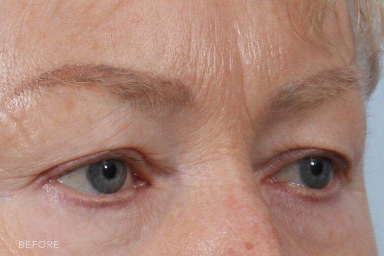 A photo of a woman's upper face shows a natural hooding of her eyes, contributing to a distinctive and unique look. | Albany, Latham, Saratoga NY, Plastic Surgery