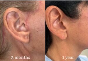 Incision lines after the deep plane facelift surgery 