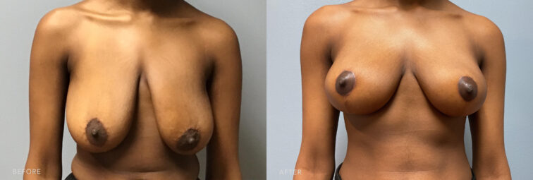 A photo of a woman's body before and after Bilateral Breast Reduction procedure. Before photo shows a considerable volume of her breast tissue, contributing to their large and heavy appearance. While the after photo shows a breasts that have been tightened and reshaped, creating a more youthful and toned appearance. | Albany, Latham, Saratoga NY, Plastic Surgery  