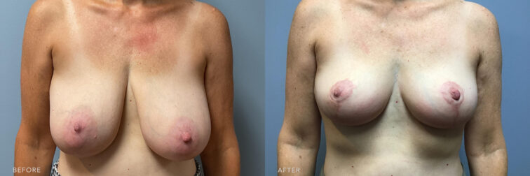 A photo of a woman's body before and after Bilateral Breast Reduction procedure. Before photo shows a breasts that hangs loosely from her chest wall and her nipple positioned below the inframmary fold. While the after photo shows a breasts that sits higher on her chest wall, creating a more youthful and rejuvenated contour. | Albany, Latham, Saratoga NY, Plastic Surgery