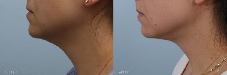 A side-by-side view of a woman's lower face before and after The Submental Liposuction procedure. Before photo shows a presence of excess fat or soft tissue beneath her chin and jaw, forming a noticeable fold. While the after photo shows a jawline with a tight and firm contour, suggesting strong underlying support structures. | Albany, Latham, Saratoga NY, Plastic Surgery