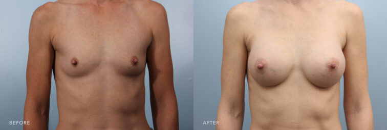A photo of a woman's body before and after a Breast Augmentation procedure. Before photo shows minimal fullness or volume in her breasts, resulting in a flatter appearance. The after photo shows well-defined and rounded breasts, with a gentle curve that extends from her chest wall. | Albany, Latham, Saratoga NY, Plastic Surgery