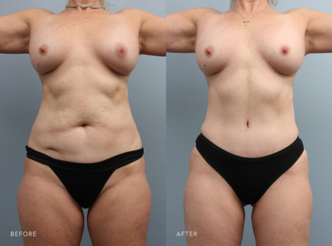 A photo of a woman's body before and after the Abdominoplasty procedure. Before photo exhibits loose or hanging skin folds, creating a visibly sagging or drooping appearance. The after photo shows a flat and well-contoured abdomen, with a smooth and even surface. | Albany, Latham, Saratoga NY, Plastic Surgery