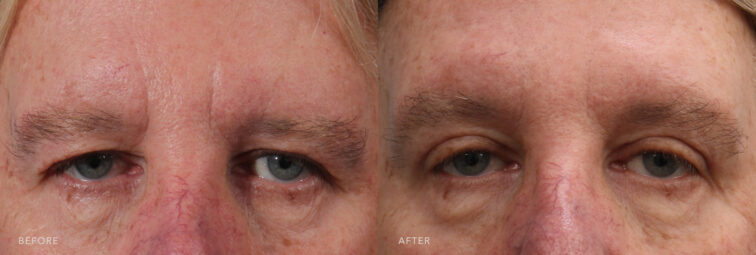 A photo of a man's upper face before and after the Bilateral Upper Sliver Blepharoplasty procedure. Before photo shows an upper eyelid that exhibits excess skin, creating a droopy or hooded appearance that partially covers his eyelid crease or lash line. The after photo shows a firm, taut, and smooth skin with a defined eyelid crease and lash line. | Albany, Latham, Saratoga NY, Plastic Surgery