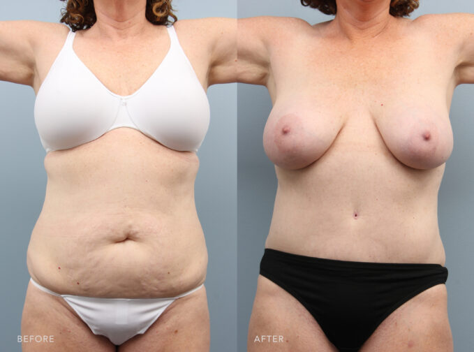 A photo of a woman's body shows before and after the Abdominoplasty procedure. Before photo shows a rounded or protruding abdomen, with excess fat deposits contributing to a chubby or overweight appearance. While the after photo shows a flatter and well-contoured abdomen, with a smoother and even surface. | Albany, Latham, Saratoga NY, Plastic Surgery