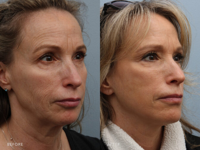 A side-by-side view of a woman's face before and after Deep Plane Lower Face and Neck Lift procedure. Before photo shows a drooping facial contours with her cheeks that appeared less lifted or defined, contributing to a more relaxed or sagging look in her lower face. While the after photo shows a well-supported and firm appearance in her facial area, contributing to a more youthful and vibrant facial aesthetics. | Albany, Latham, Saratoga NY, Plastic Surgery