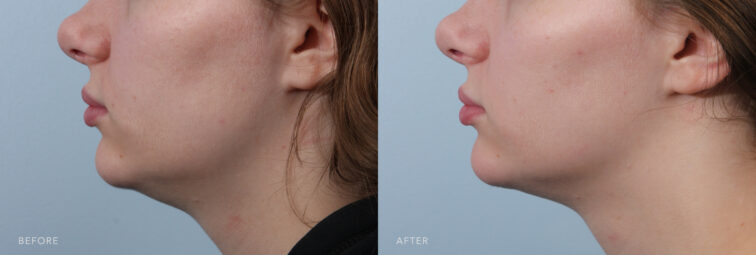 A side-by-side view of a woman's lower face before and after the Submental Liposuction and Buccal Fat Removal procedure. Before photo shows bulging skin below her chin, contributing to the appearance of a double chin or fullness in her lower face and neck and affecting overall facial aesthetics and contour. The after photo shows a proportionate size and shape of her jawline, creating a balanced and harmonious aesthetic. | Albany, Latham, Saratoga NY, Plastic Surgery