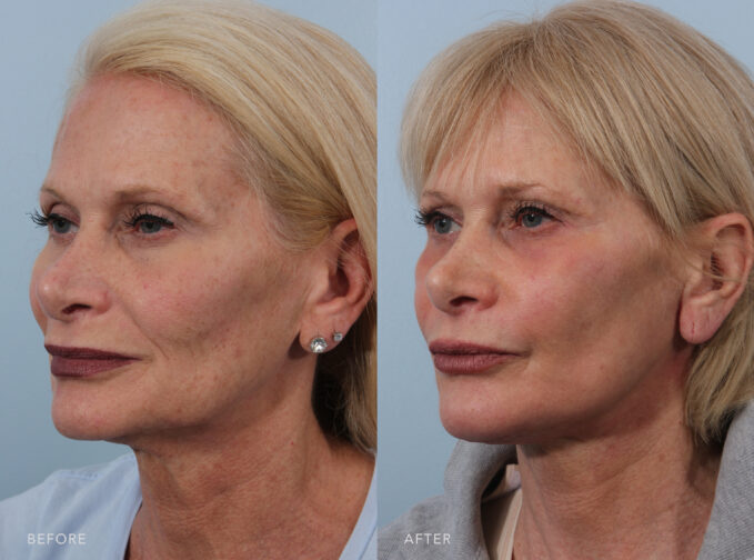 A side-by-side view of a woman's face before and after Deep Neck Lift and 35% Chemical Peel procedure. Before photo shows sagging skin on her neck, contributing to the formation of jowls, causing the lower portion of her face to appear less defined. The after photo shows smoother skin on the neck area, indicating adequate hydration, with the skin appearing plump and moisturized. | Albany, Latham, Saratoga NY, Plastic Surgery
