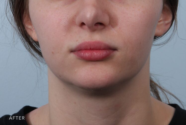 A photo of a woman's lower face shows a well-defined and sculpted appearance, with a distinct angle and contour along the lower border of her jaw. | Albany, Latham, Saratoga NY, Plastic Surgery