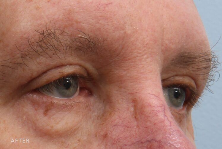 A photo of a man's upper face shows no noticeable excess skin on his upper eyelid, allowing for a more open and alert appearance of his eyes. | Albany, Latham, Saratoga NY, Plastic Surgery