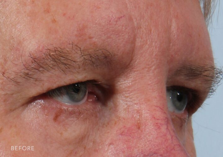 A photo of a man's upper face having excess skin that is localized to his upper eyelid, extending from the eyelid margin to the brow bone. | Albany, Latham, Saratoga NY, Plastic Surgery