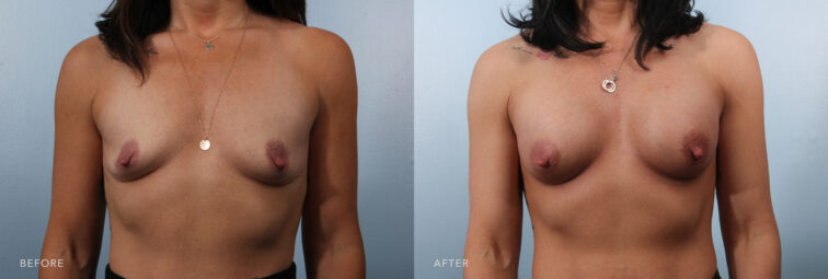 A photo of a woman's body before and after the Bilateral Breast Augmentation procedure. Before photo shows small-sized breasts compared to average or larger breasts, with less volume and projection. The after photo shows a moderate degree of fullness and volume, providing a balanced and proportionate appearance to her chest. | Albany, Latham, Saratoga NY, Plastic Surgery 