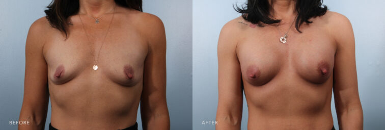 A photo of a woman's body before and after the Bilateral Breast Augmentation procedure. Before photo shows small-sized breasts compared to average or larger breasts, with less volume and projection. The after photo shows a moderate degree of fullness and volume, providing a balanced and proportionate appearance to her chest. | Albany, Latham, Saratoga NY, Plastic Surgery