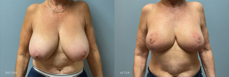 A photo of a woman's body before and after the Bilateral Breast Reduction procedure. Before photo shows heavy breasts that affect her posture, causing the shoulders to roll forward and the upper back to round. The after photo shows an improved symmetry between her breasts, with a more balanced size and shape. | Albany, Latham, Saratoga NY, Plastic Surgery 