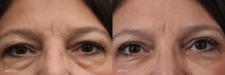 A photo of a woman's upper face before and after the Upper/Lower Blepharoplasty procedure. Before photo shows excess skin or fat drooping downward over her upper eyelid, partially covering the natural crease and eyelashes. The after photo shows a firmer and more resilient to the touch, with a noticeable decrease in laxity or drooping on her upper eyelid. | Albany, Latham, Saratoga NY, Plastic Surgery