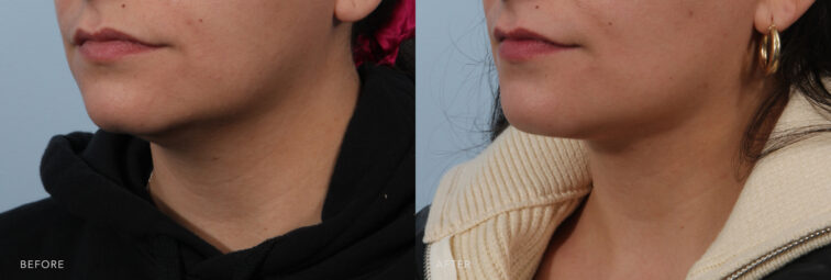 A side-by-side view of a woman's lower face before and after the Neck Liposuction procedure. Before photo exhibits variations or inconsistencies on both sides of her face, resulting in a less defined or less balanced appearance. The after photo shows a well-structured jawline that exhibits a clear and defined contour along the lower border of her jaw, creating a distinct separation between the jaw and neck.| Albany, Latham, Saratoga NY, Plastic Surgery