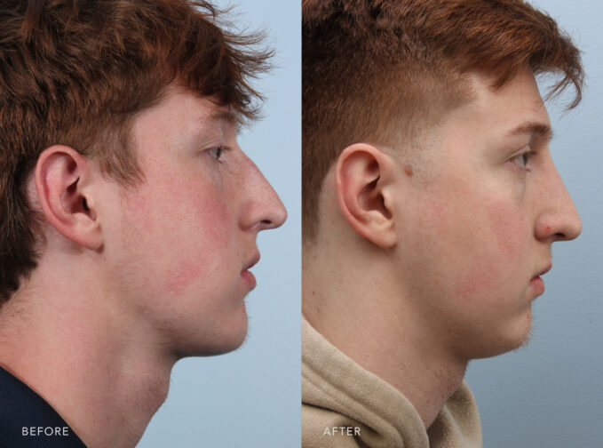 A side-by-side view of a man's face before and after Endonasal Cosmetic Rhinoplasy procedure. Before photo shows his nostrils that appears to be pulled upward or widened, contributing to the overall bowing shape of his nose. While the after photo shows symmetrical and in harmony with the overall shape of his nose, neither flared nor pinched. | Albany, Latham, Saratoga NY, Plastic Surgery