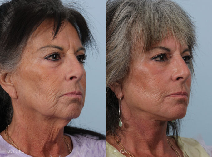 A side-by-side view of a woman's face before and after the Deep Plane Lower Face and Neck Lift procedure. Before photo shows loss of skin elasticity and firmness, resulting in sagging or drooping of her facial contours, including the cheeks, jowls, and neck. The after photo shows firm and well-defined facial contours, including a sculpted jawline, lifted cheeks, and taut skin, adding to a youthful and rejuvenated appearance. | Albany, Latham, Saratoga NY, Plastic Surgery