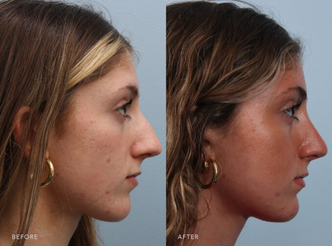 A side-by-side view of a woman's face before and after the Rhinoplasty procedure. Before photo shows an off-centered nasal bridge or tip, creating an irregular or unbalanced appearance when viewed from the front or profile. The after photo shows a centered nasal tip between her nostrils and maintains a straight projection from her face, with no noticeable deviation or tilt to either side. | Albany, Latham, Saratoga NY, Plastic Surgery 