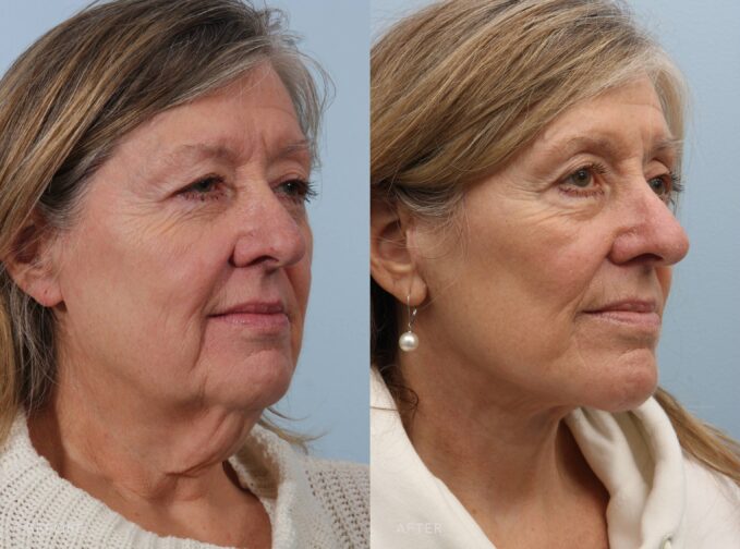 A side-by-side view of a woman's face before and after the Deep Plane Lower Face and Neck Lift procedure. Before photo shows visible neck bands or loose skin indicates aging and the loss of skin elasticity. The after photo shows subtle tightness and is natural, avoiding an over-stretched or artificial appearance and maintaining her natural beauty and expression. | Albany, Latham, Saratoga NY, Plastic Surgery