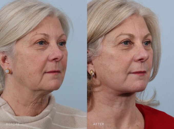 A side-by-side view of a woman's face before and after the Cosmetic Rhinoplasty procedure. The before photo shows thick or oily nasal skin, especially around the tip, impacting refinement. The after photo shows a smoother and more structured nasal tip as it settles over the refined cartilage. | Albany, Latham, Saratoga NY, Plastic Surgery