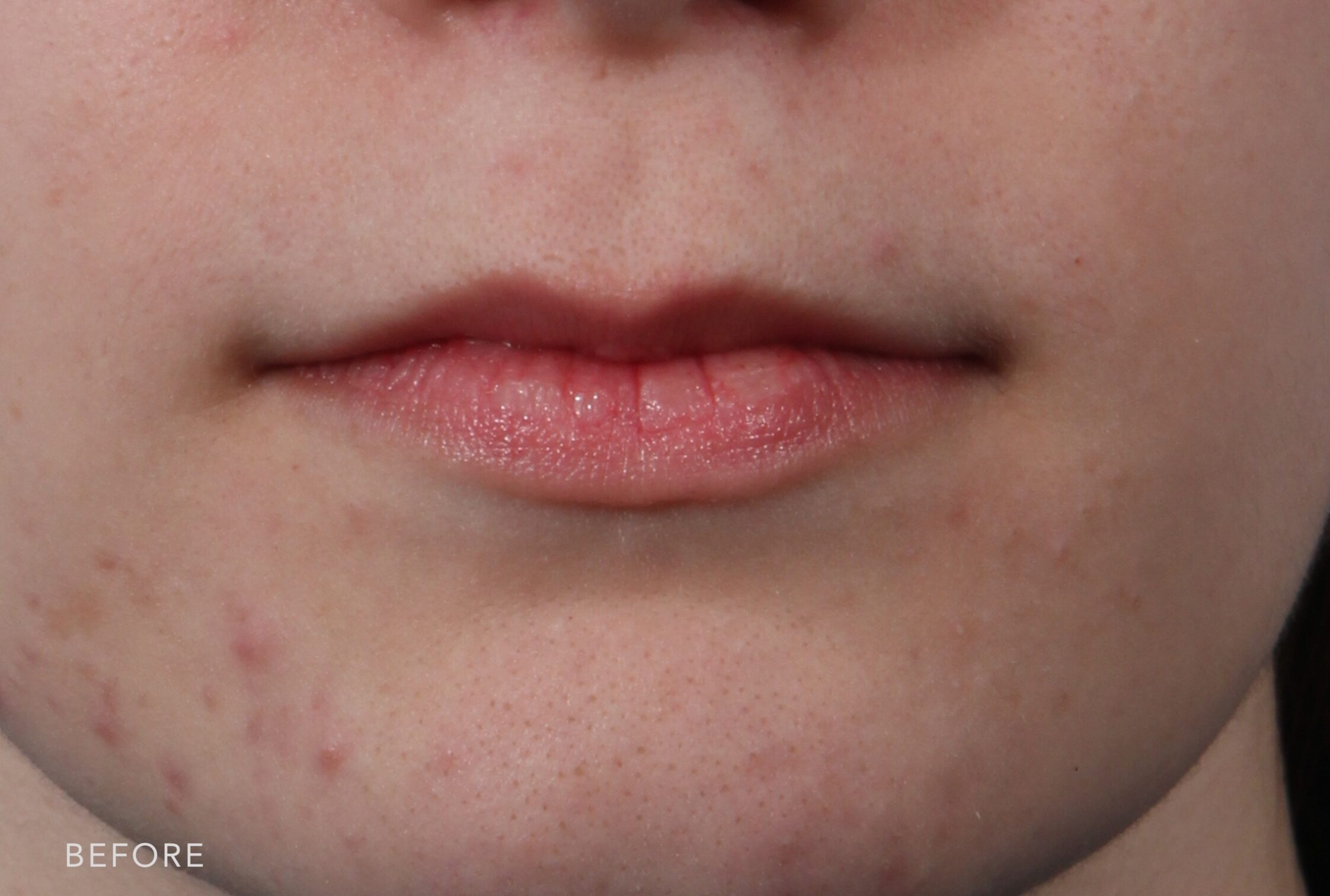 6 Weeks Post-Op Lip Lift - The Williams Center Williams Center