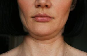 Lower Facelift New York