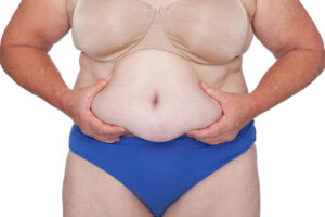 Am I A Candidate for A Panniculectomy?