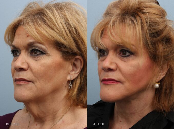 A side-by-side view of a woman's face before and after the Deep Plane Lower Face and Neck Lift procedure. Before photo shows a shortened neck appearance due to the extra volume under her chin, her neck appears shorter and less elongated, impacting her overall facial profile. The after photo shows a longer, elongated neck appearance with the removal of excess fat. Her neck appears longer and more elegant, enhancing the overall balance and harmony of her face. | Albany, Latham, Saratoga NY, Plastic Surgery