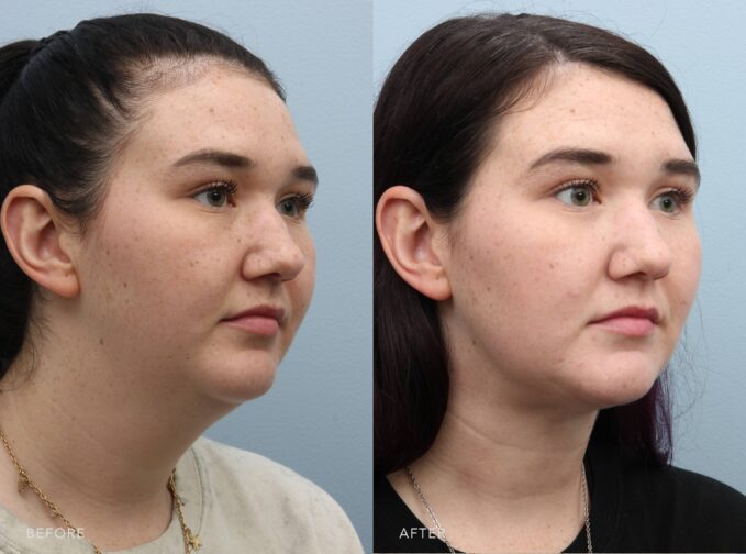 A side-by-side view of a woman's face before and after the Deep Plane Lower Face and Neck Lift procedure. Before photo shows redistribution or sagging of fat in her lower face, masking the jawline's angularity. The after photo shows a defined chin-to-neck angle, creating a sleek and elegant side profile. | Albany, Latham, Saratoga NY, Plastic Surgery