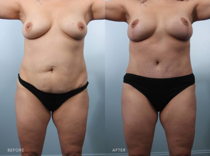 A photo of a woman's body before and after the Tummy Tuck w/ Liposuction procedure. Before photo shows an undefined waistline due to excess fat and skin, lacking a contoured hourglass shape. The after photo shows a defined waistline with a more cinched and sculpted, enhancing the curves and her overall body balance. | Albany, Latham, Saratoga NY, Plastic Surgery