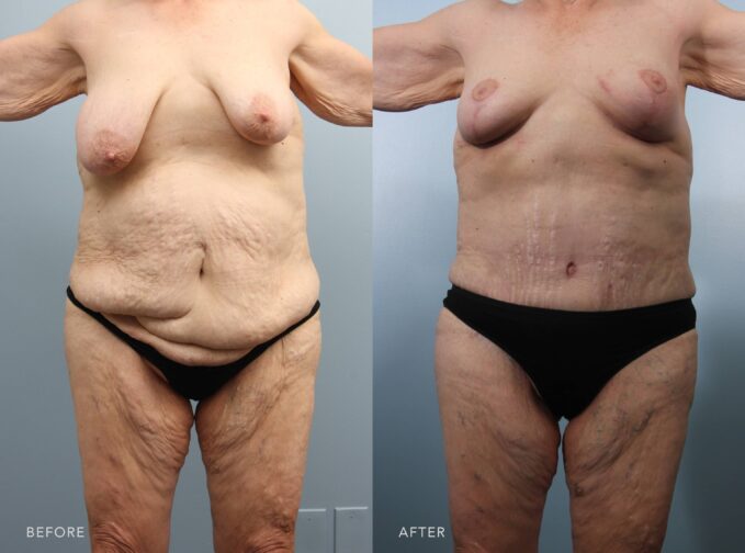 A photo of a woman's body before and after the Tummy Tuck with Liposuction, Bilateral Breast Lift, Fat Transfers to Breast procedure. The before photo shows wrinkled, sagging skin in her abdomen, waist, flanks, thighs, or back, affecting her body contour. The after photo shows a slimmer, more contoured midsection and smoother curves with her tightened skin, maintaining a more proportionate and balanced body contour. | Albany, Latham, Saratoga NY, Plastic Surgery