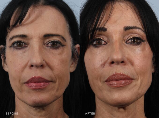 A photo of a woman's face before and after the Brow Lift and Fat Grafting procedure. The before picture shows a drooping or low-positioned brow, giving a tired or heavy look. There is also a loss of facial volume, especially in her cheeks and under her eyes, leading to a sunken appearance. The after photo shows elevated, naturally arched brows, creating a more awake and refreshed expression and fuller, rounder cheeks, restoring her youthful volume and softness. | Albany, Latham, Saratoga NY, Plastic Surgery