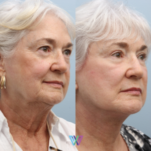 Facelift: Woman in 70's