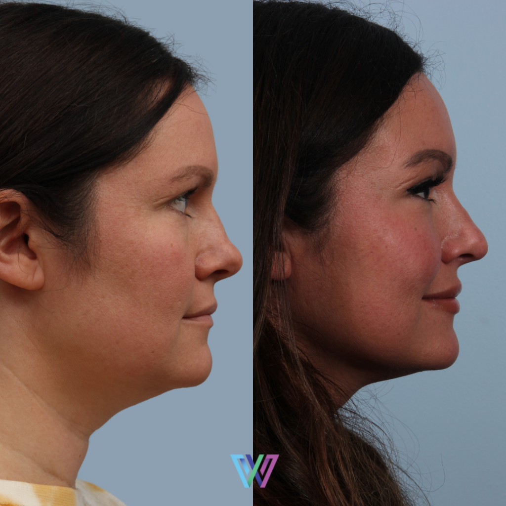 rhinoplasty b&A