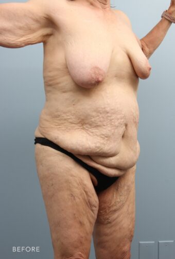 A photo of a woman's body shows sagging or drooping breasts, especially in the upper portion, making them appear deflated. | Albany, Latham, Saratoga NY, Plastic Surgery