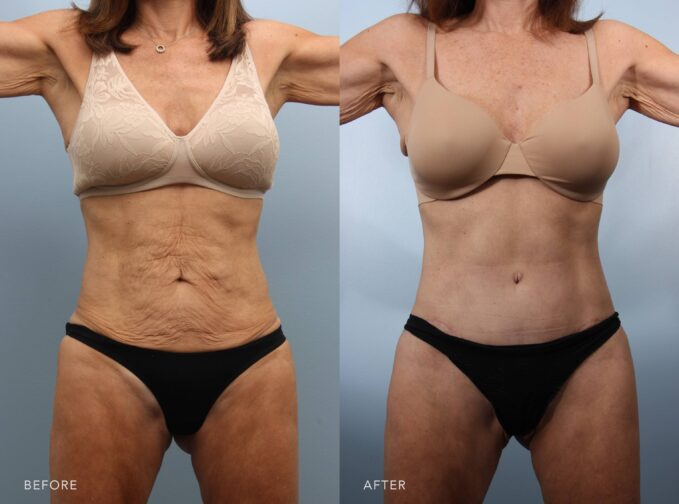 A photo of a woman's body before and after the Tummy tuck & Lower Body Lift procedure. The before picture shows a lack of tone and definition, with soft, sagging areas disrupting the silhouette. The after photo shows a rejuvenated, youthful, and proportionate body, with a clear improvement in skin tone and firmness. | Albany, Latham, Saratoga NY, Plastic Surgery