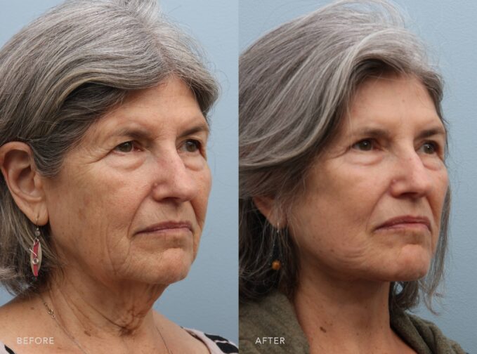 A side-by-side view of a woman's face before and after the Deep Plane Lower Face and Neck Lift procedure. The before photo shows a loss of structural support on her facial skin, showing deeper wrinkles and sagging around the cheeks, jawline, and eyes. The after photo shows a well-supported and lifted facial skin with a strong underlying structure that maintains her youthful contours. | Albany, Latham, Saratoga NY, Plastic Surgery