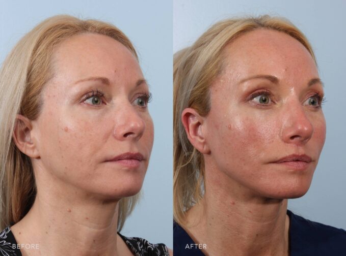 A side-by-side view of a woman's face before and after the Deep Plane Facelift and Lip Lift procedure. The before photo shows a neck that exhibits mild skin laxity with slight fullness under her chin. The jawline lacks sharp definition, and there’s a smooth but less contoured transition from her face to the neck. The after photo shows firm, taut skin with no visible laxity or fullness beneath the chin. The jawline is sharply defined, creating a crisp, sculpted transition from the face to the neck. | Albany, Latham, Saratoga NY, Plastic Surgery