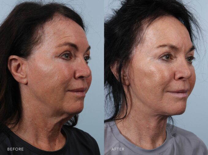 A side-by-side view of a woman's face before and after the Deep Plane Lower Face and Neck Lift procedure. The before photo shows a lack of volume in her midface, particularly on the cheeks and under the eye area, creating shadows and a more tired or aged look. The after photo shows a midface that appears complete and lifted, with soft, youthful contours that enhance the shape of her cheeks and under-eye area. | Albany, Latham, Saratoga NY, Plastic Surgery