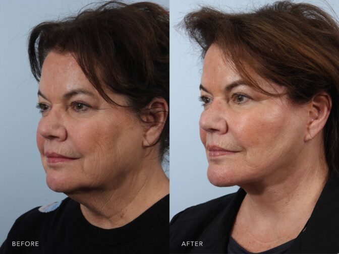 A side-by-side view of a woman's face before and after the Deep Plane Lower Face and Neck Lift procedure. The before photo shows wrinkles and fine lines along her jaw, particularly near the chin and extending toward the neck. The after photo shows a sharp and sculpted jawline, creating a clear separation between her face and neck. | Albany, Latham, Saratoga NY, Plastic Surgery