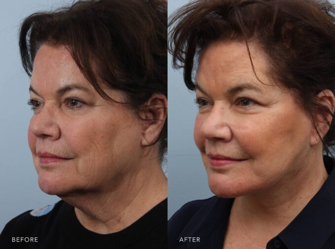 A side-by-side view of a woman's face before and after the Deep Plane Lower Face and Neck Lift procedure. The before photo shows wrinkles and fine lines along her jaw, particularly near the chin and extending toward the neck. The after photo shows a sharp and sculpted jawline, creating a clear separation between her face and neck. | Albany, Latham, Saratoga NY, Plastic Surgery